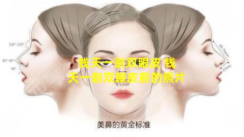 钱天一割双眼皮 钱天一割双眼皮前的照片